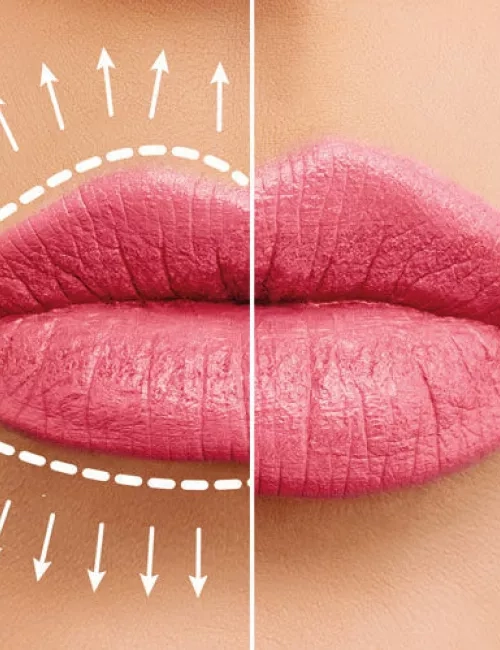 Nahaufnahme von Lippen mit rosafarbenem Lippenstift, links mit eingezeichneten Linien zur Veranschaulichung einer kosmetischen Behandlung, rechts das Ergebnis nach der Behandlung.