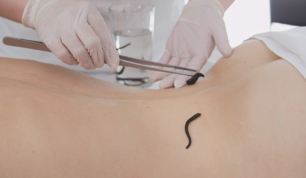 In einem hellen Raum liegt eine Patienten auf dem Bauch mit frei gelegten Rücken, es werden zwei schwarze Wurmartige Blutegel auf den unteren Rückenbereich angelegt. Der Therapeut oder die Therapeutin legt die Blutegel mit einer silbernen Zange auf die Behandelte Stelle an. Dabei werden weiße Handschuhe getragen und im Hintergrund befinden sich weitere Blutegel in einem Reagenzglas mit Wasser. 