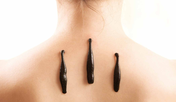 Drei Blutegel befinden sich auf dem oberen Rücken einer Person mit freier Schulterpartie – eine traditionelle Heilmethode in ruhiger, heller Umgebung.