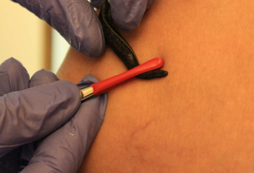 Eine nackige Hautpartie wird sehr nah abgebildet und auf der Stelle wird ein dunkler Blutegel mit einer roten, kleinen Zange angelegt. Der Therapeut trägt lila Handschuhe. 